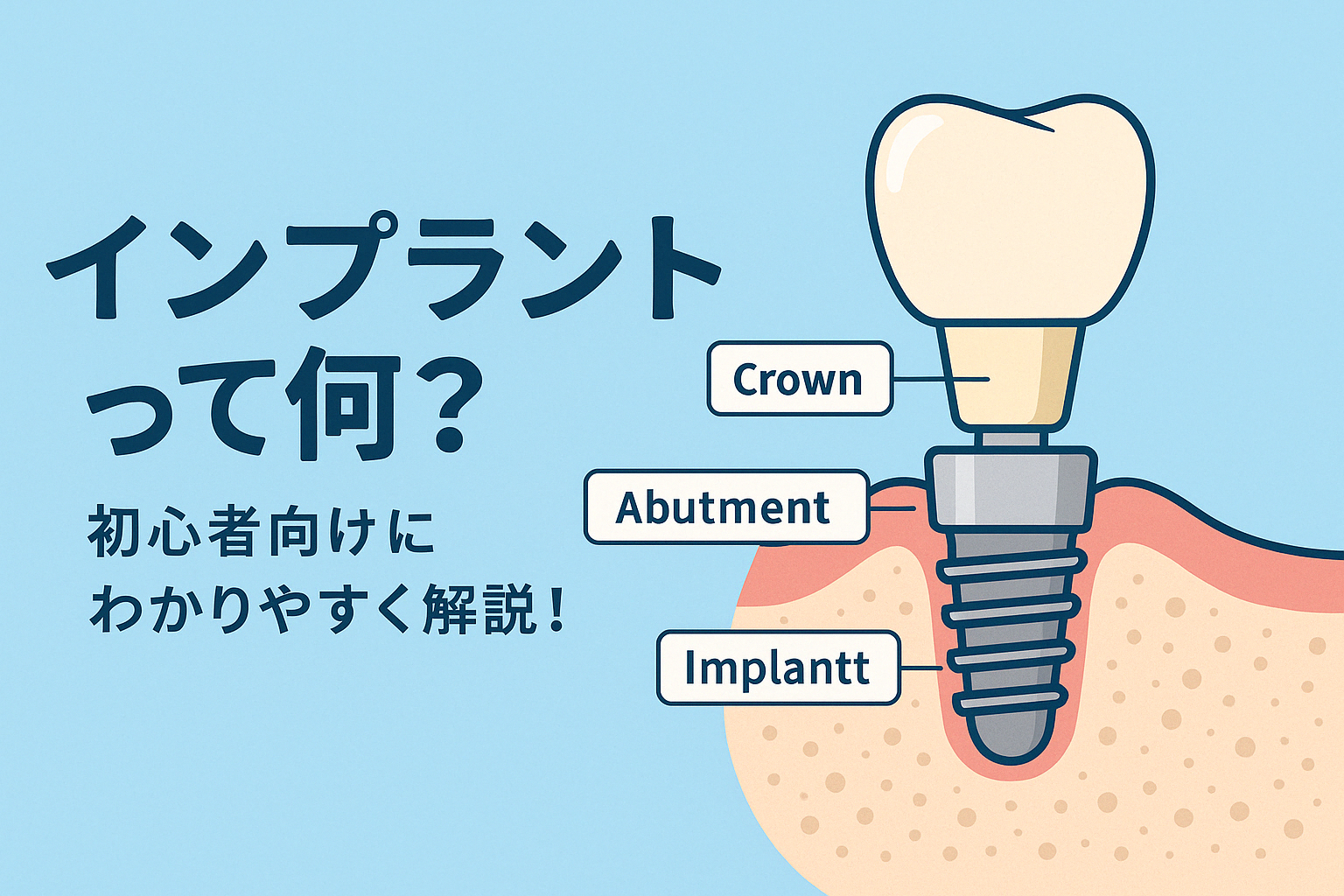 インプラントの仕組み・構造とは？