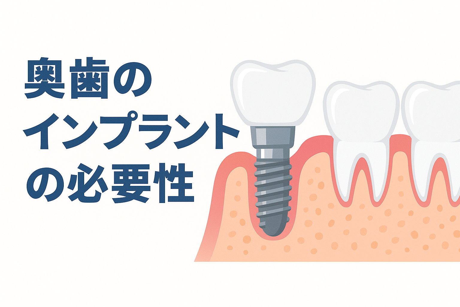 奥歯のインプラントの必要性