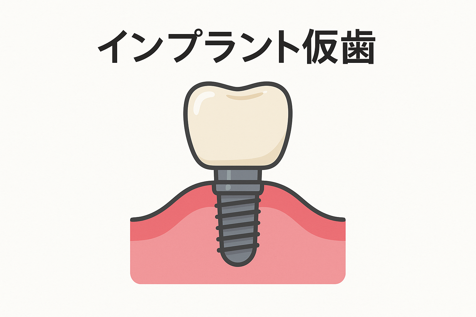 インプラント治療の仮歯について