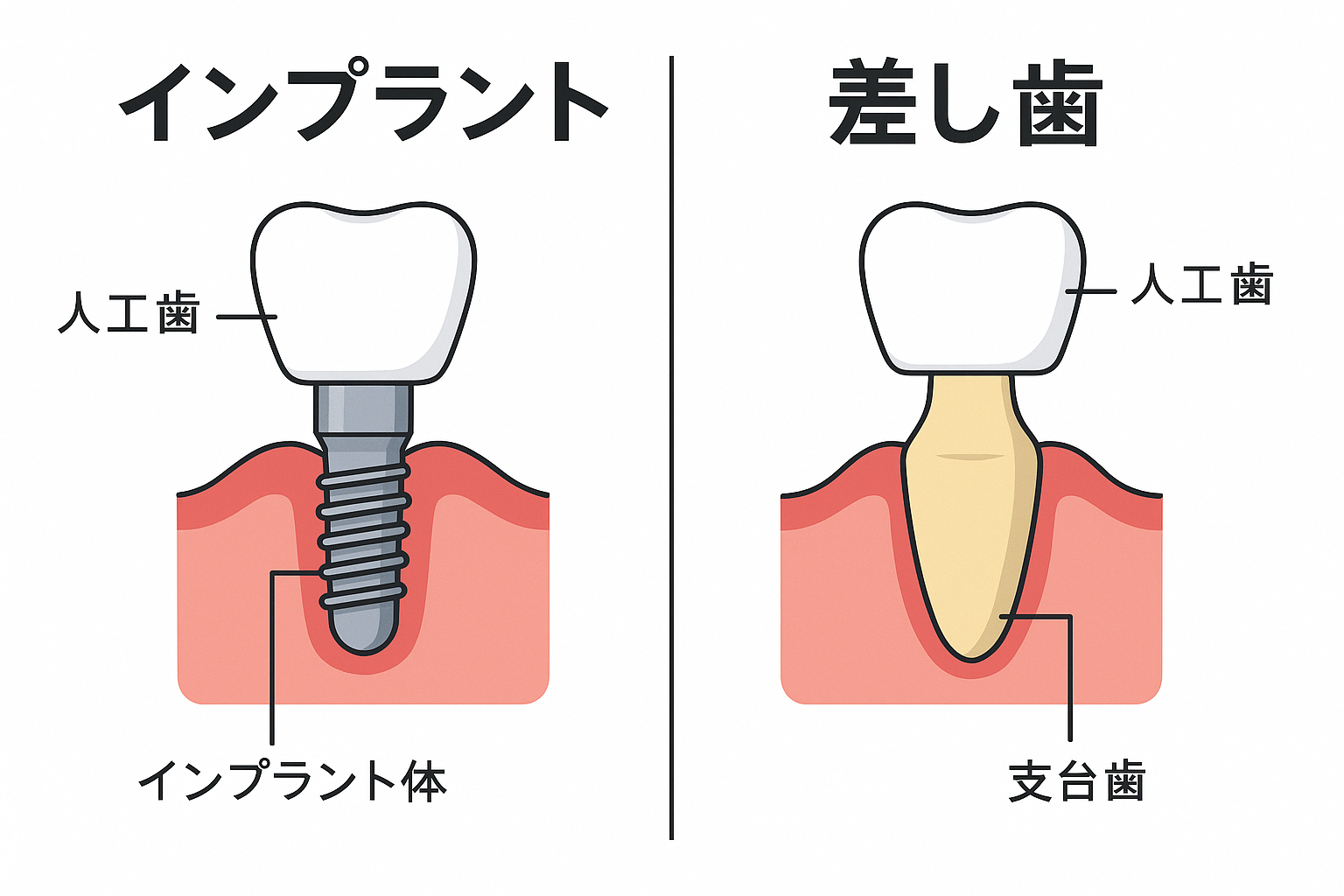 インプラントと差し歯との違いとは？ 治療方法・流れ・費用の目安も紹介